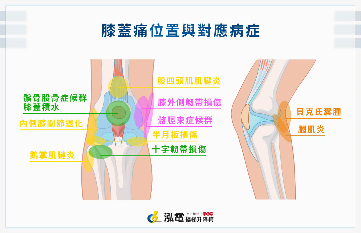 膝蓋痛位置與對應病症解析